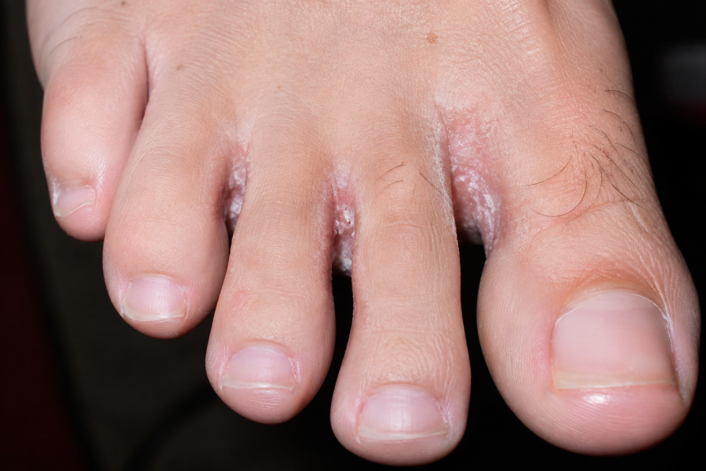 Athlete's foot symptoms between the toes