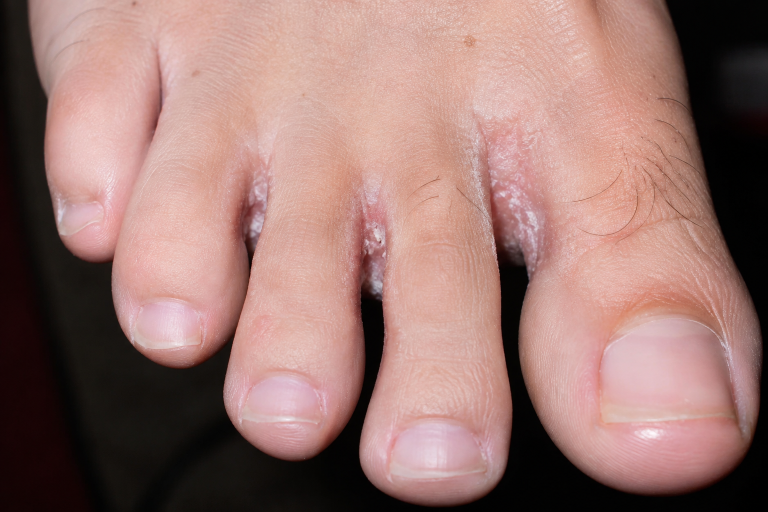 Athlete's foot symptoms between the toes